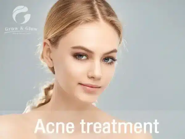 Acne treatment