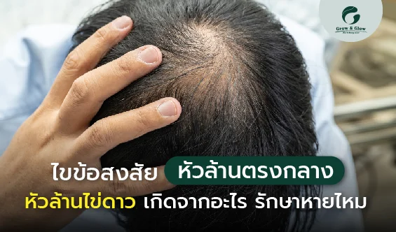 หัวล้านตรงกลาง หัวล้านไข่ดาว เกิดจากอะไร รักษาได้ไหม - grow and glow