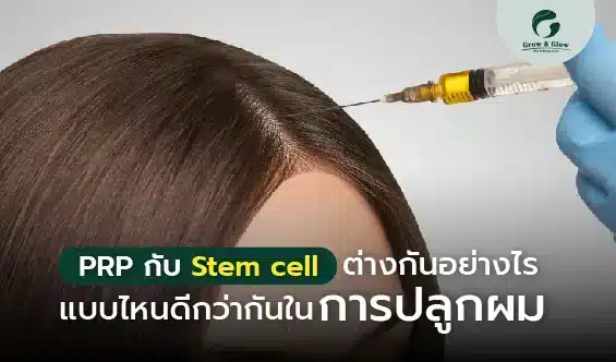 PRP Stem cell คืออะไร วิธีไหนดีกว่าในการปลูกผม - grow and glow