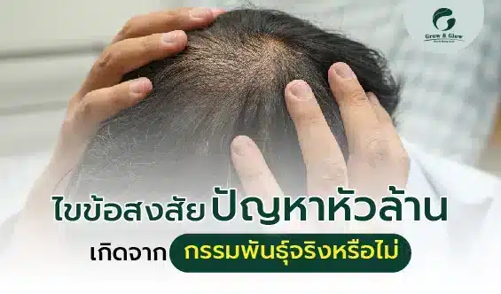 ปัญหาหัวล้าน สร้างความกังวลให้ผู้คนได้ไม่น้อย