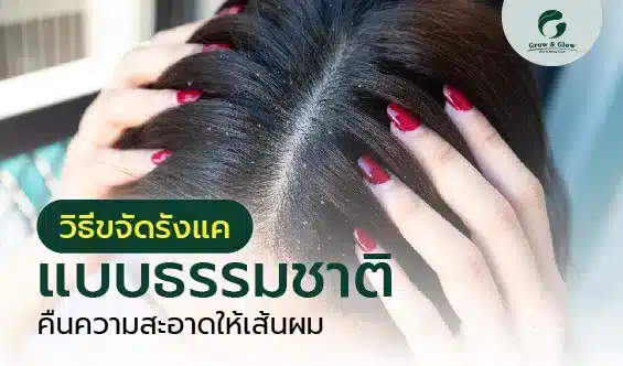 รังแค ปัญหาใหญ่ที่ไม่ควรมองข้าม