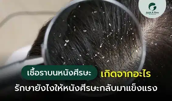 เชื้อราบนหนังศีรษะ ทำให้ผมร่วงเป็นวง