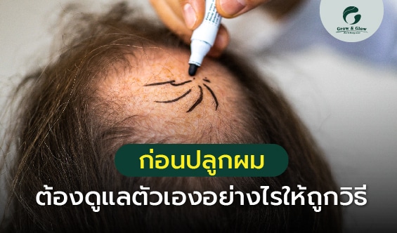 ก่อนปลูกผม ต้องดูแลตัวเองอย่างไรให้ถูกวิธี