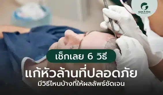 เช็กเลย 6 วิธีแก้หัวล้านที่ปลอดภัย มีวิธีไหนบ้างที่ให้ผลลัพธ์ชัดเจน