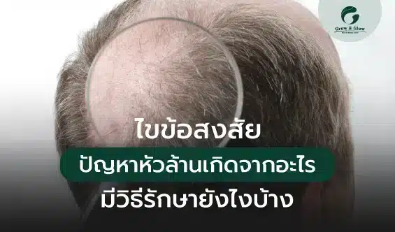 ปัญหาหัวล้านเกิดจากอะไร แก้ด้วยการปลูกผมได้ไหม