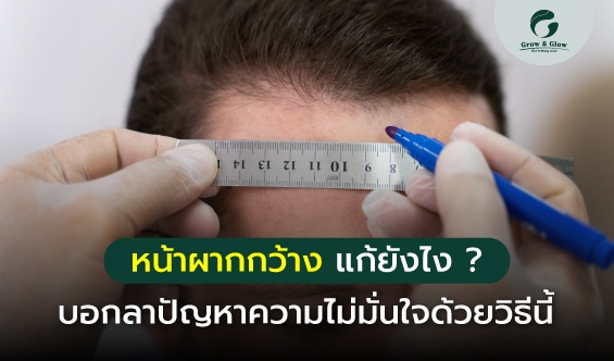 หน้าผากกว้าง แก้ยังไง ? บอกลาปัญหาความไม่มั่นใจด้วยวิธีนี้