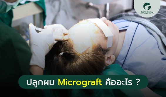 ปลูกผม Micrograft คืออะไร ? อธิบายทุกข้อสงสัยแบบเข้าใจง่าย