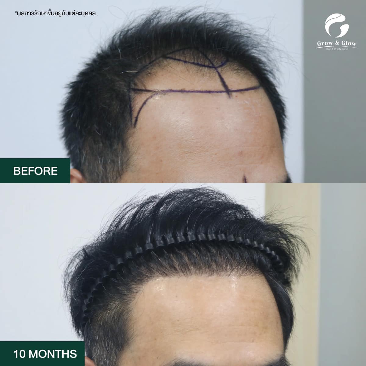 รีวิวปลูกผมเทคนิค FUT ที่ Grow & Glow