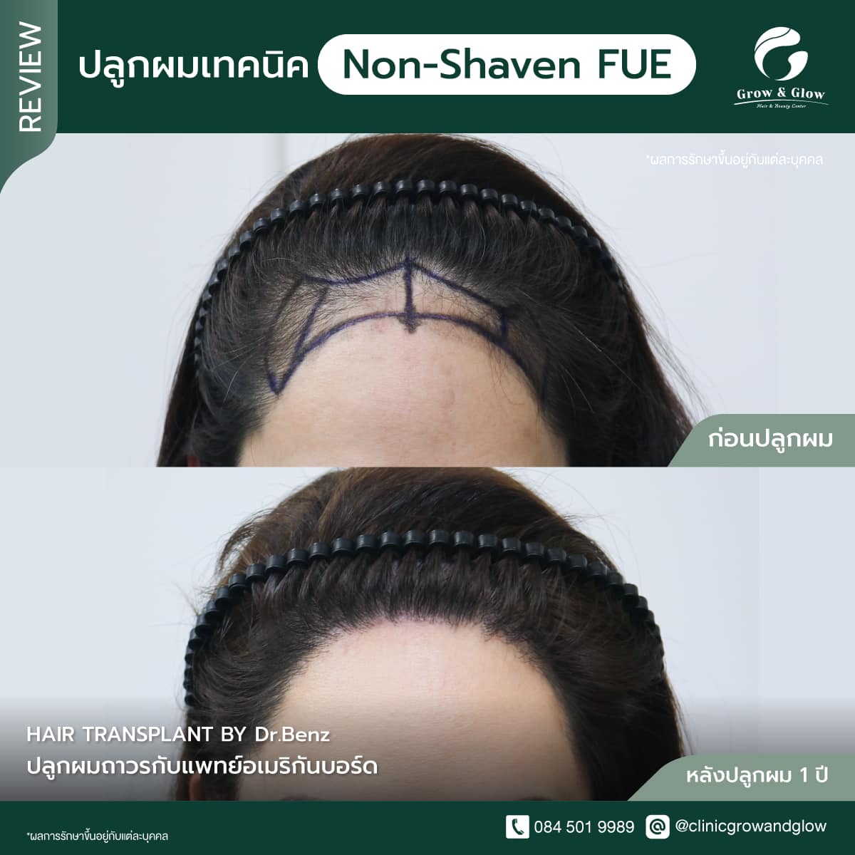 รีวิวปลูกไรผมผู้หญิงด้วยเทคนิค FUE ที่ Grow & Glow