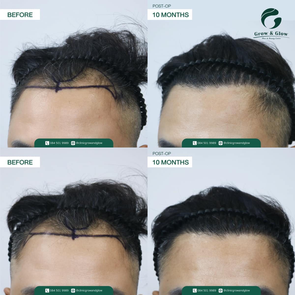 รีวิวผลลัพธ์หลังการปลูกผมถาวร FUT ที่ Grow & Glow