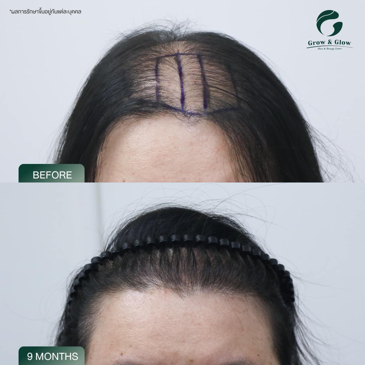 รีวิวปลูกไรผมผู้หญิงด้วยเทคนิค FUT ที่ Grow & Glow