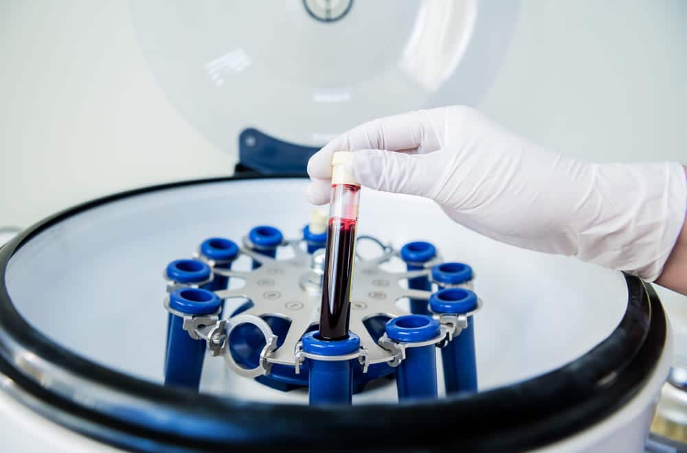 กระบวนการ PRP (Platelet-Rich Plasma) เพื่อรักษาภาวะผมร่วงเพราะฮอร์โมน