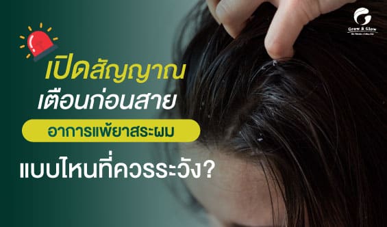เผยอาการแพ้ยาสระผมและวิธีรับมือ รู้ให้ทันก่อนผมร่วงเยอะ !