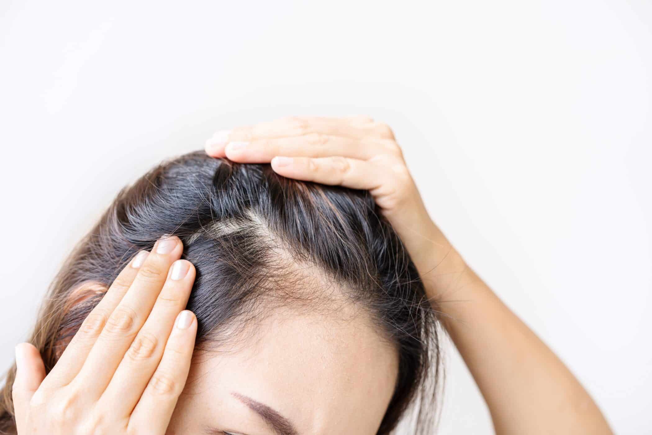 Women's hair loss is often first noticed by parting the hair