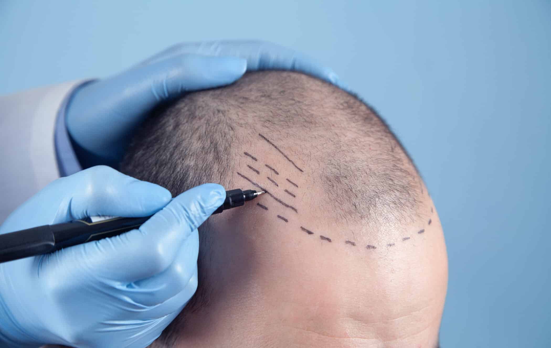 A man prepares to undergo a hair transplant