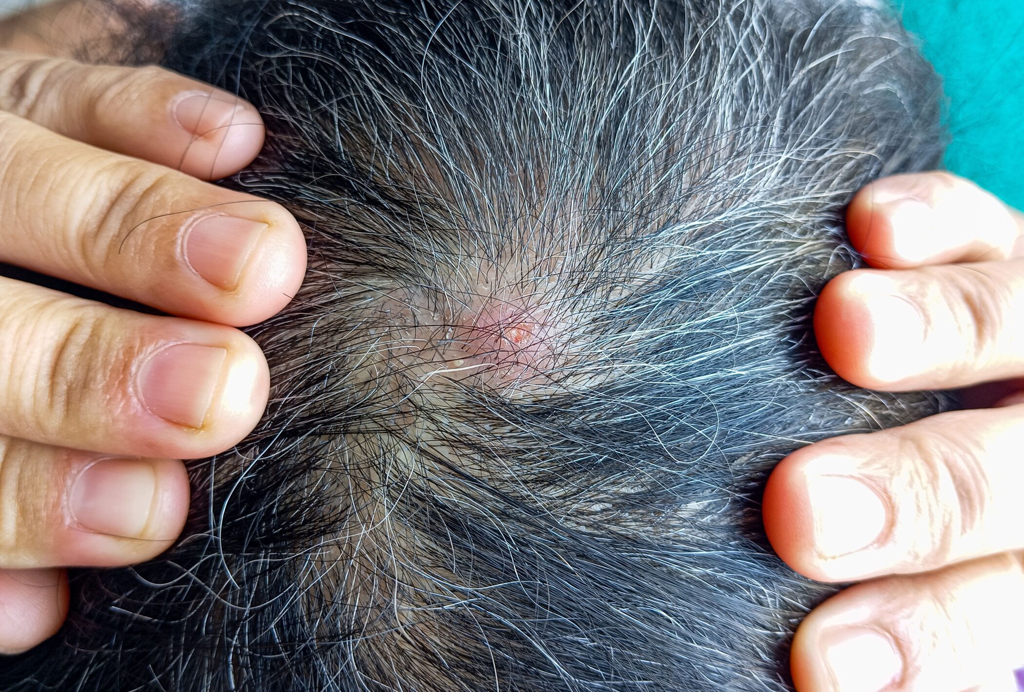 สิวขึ้นหัวเป็นปัญหาที่สร้างความรำคาญใจ