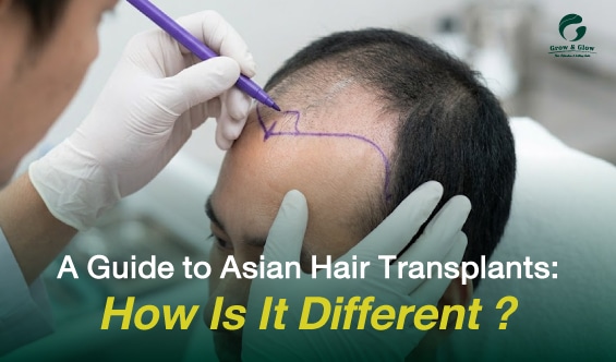 What is an Asian Hair Transplant? How Is It Different?