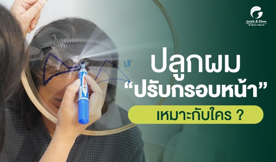 ปลูกผมปรับกรอบหน้าเหมาะกับใคร ? พร้อมข้อดีและเรื่องที่ควรรู้