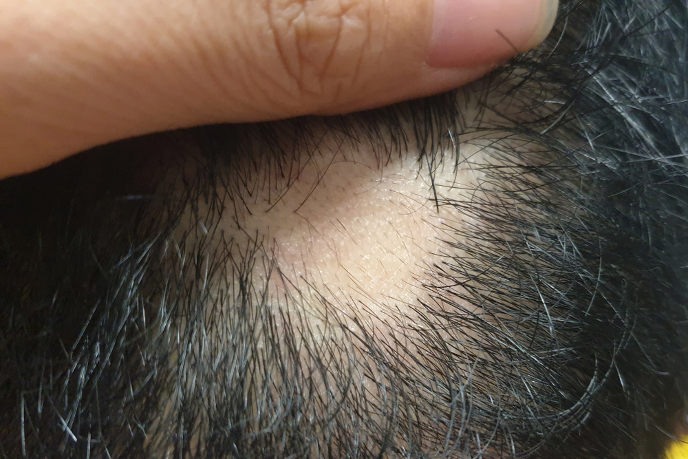 Patchy hair loss on the scalp, a common visible sign of alopecia areata