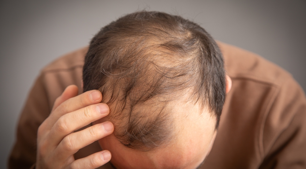 ชายวัยกลางคนมีปัญหาผมร่วงตามกรรมพันธุ์ จึงใช้ยาปลูกผม Finasteride เพื่อลดผมร่วง