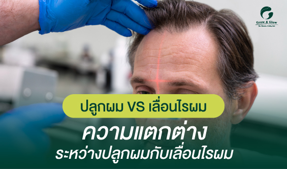 ปลูกผม VS เลื่อนไรผม ต่างกันยังไง คุณเหมาะกับแบบไหนมากกว่า ?
