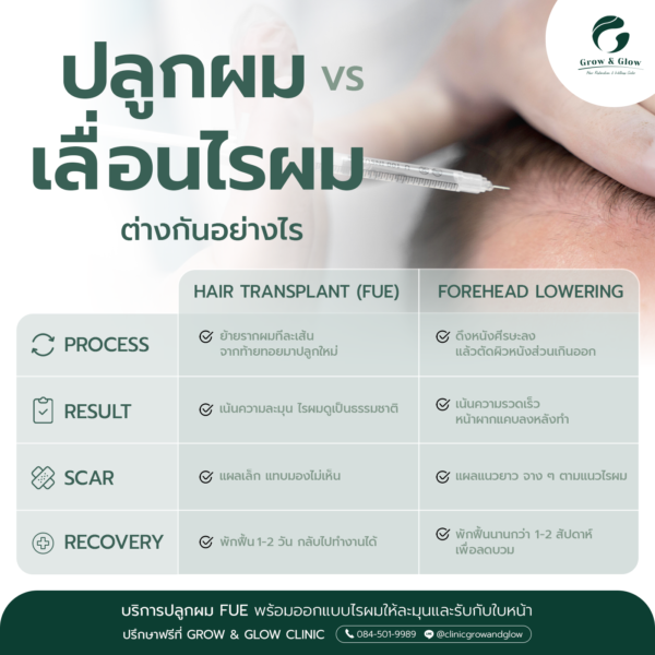 ปลูกผม VS เลื่อนไรผม ต่างกันอย่างไร วิธีไหนดีกว่า ?