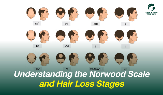 Understanding the Norwood Scale and Hair Loss Stages