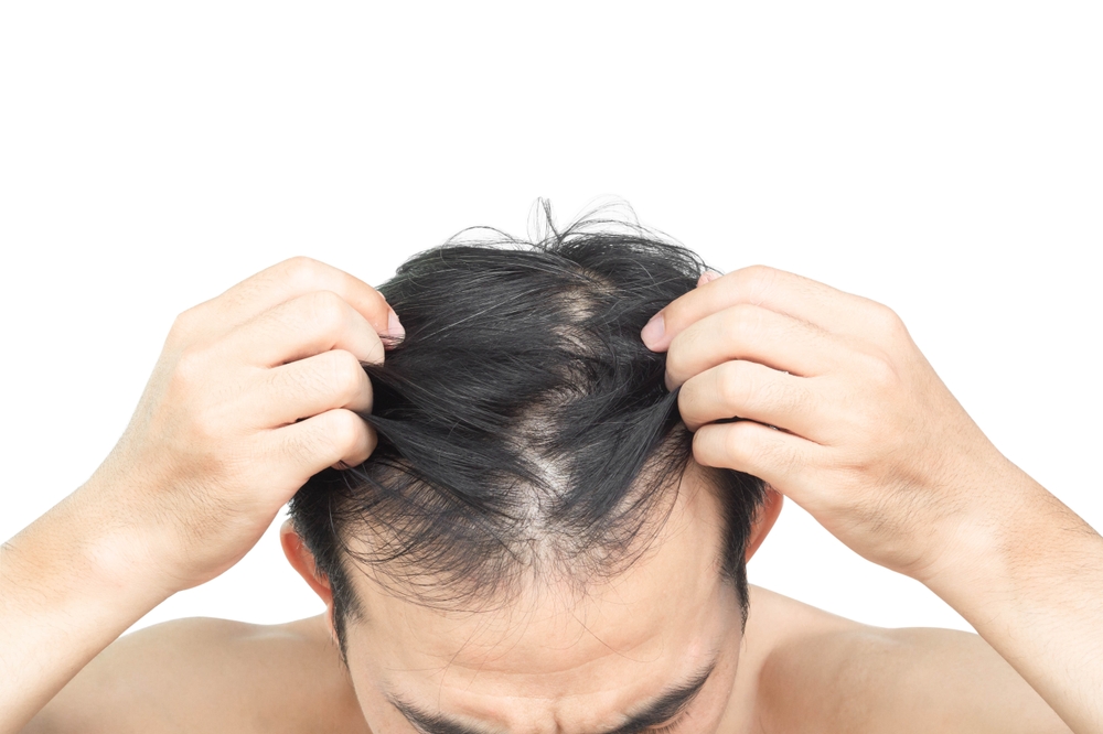 Close up of a man's scalp showing hair thinning at the crown and part line