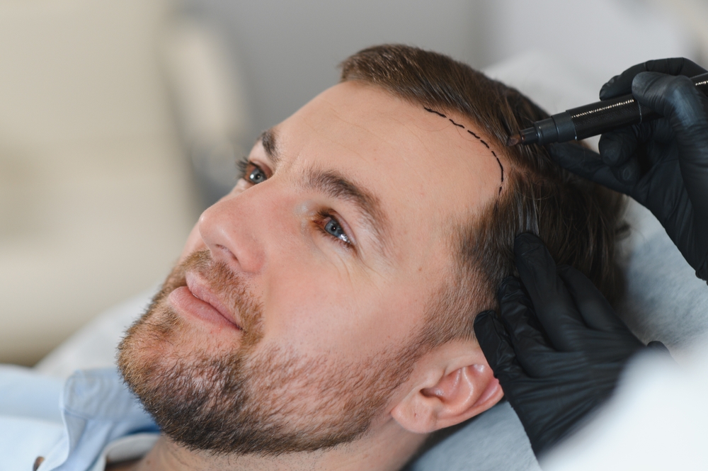 Man beginning his hair transplant journey at the start of the hair transplant recovery process
