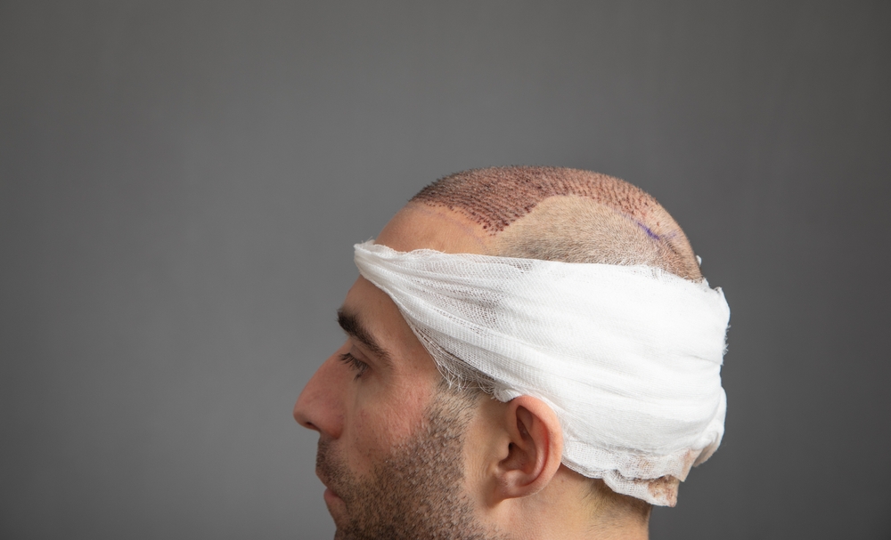 Man right after a hair transplant preparing for the early recovery period