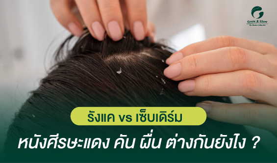 รังแค vs เซ็บเดิร์ม ปัญหาหนังศีรษะอักเสบที่ห้ามปล่อยไว้