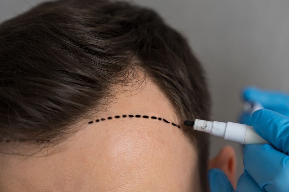 Hairline marking for hair transplant bangkok.