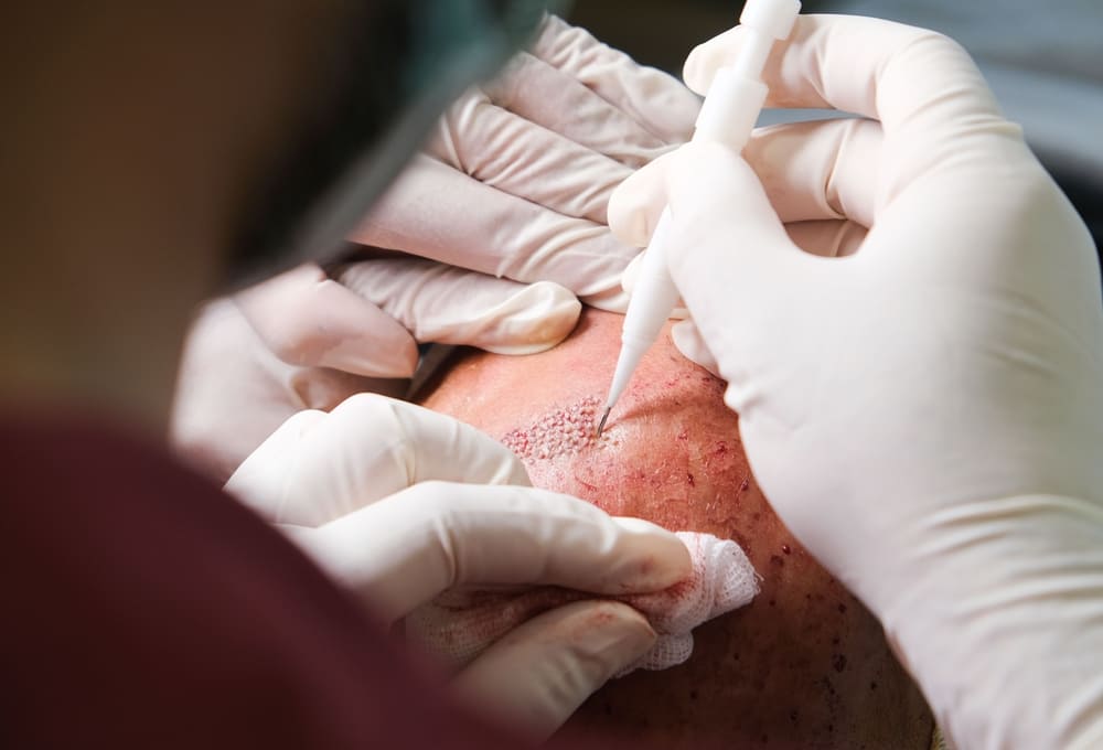 Surgeon placing hair grafts during hair transplant aftercare procedure.
