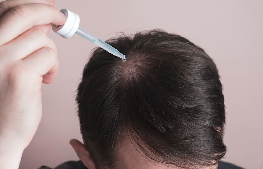 Man applying serum for minoxidil timeline.